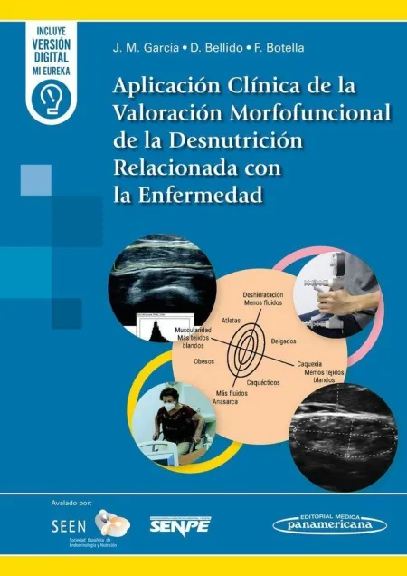 Aplicacion Clinica de Valoracion Morfofuncional de la Desnutrición Relacionada con la Enfermedad