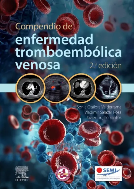 Compendio de Enfermedad Tromboembolica Venosa